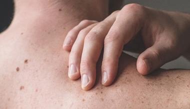 Checking benign moles. Close up detail of the bare skin on a man back with scattered moles and freckles. Sun effect on skin. Birthmarks on skin