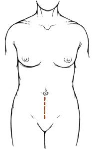 下中线切口图，从腹部到腹股沟有一条垂直线