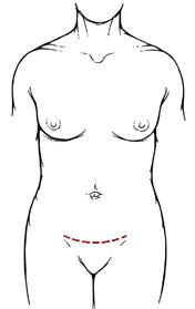 Pfannenstiel切口图，显示一条横过腹股沟的水平线