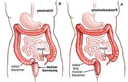 直结肠切除术与结肠切除术手术方法的比较