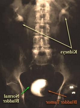 Intravenous pyelogram image showing the kidneys, bladder and bladder tumor.