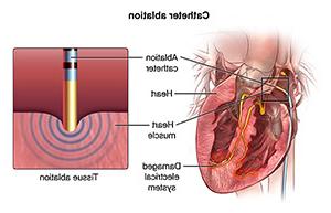 查看心脏电系统和导管就位情况. 导管进行组织消融的特写.