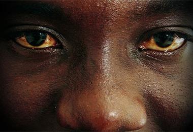 A man with bloodshot uveitis-afflicted eyes.