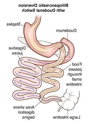 Front view of stomach showing biliopancreatic diversion with duodenal switch. 箭头显示食物和消化液的路径.